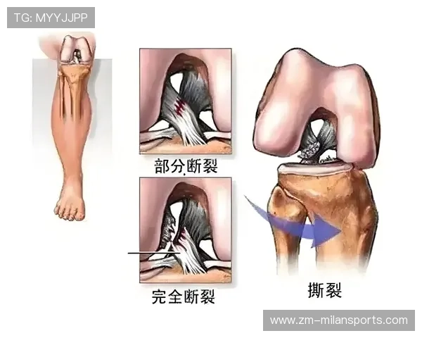 膝盖前交叉韧带术后的 2026 最新物理治疗方案：如何有效缩短 40% 的康复期。